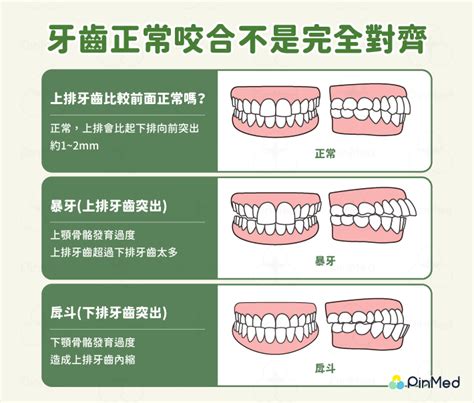 上排牙齒蓋住下排牙齒|牙齒咬合重要嗎？原來上下排牙齒咬合沒那麼簡單